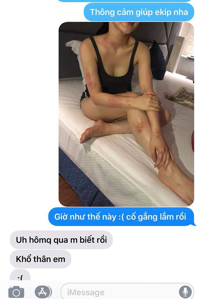 Hoảng hốt trước làn da nổi đầy mụn đỏ và ngứa vì bị dị ứng cấp tính của hương tràm