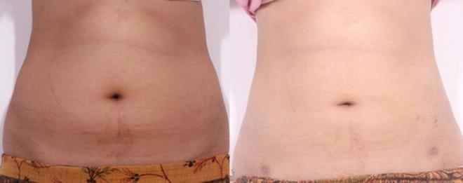 Hút mỡ bụng có thật sự là phương pháp thẩm mỹ thần thánh như quảng cáo