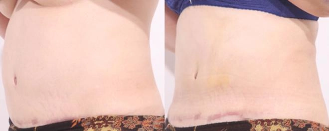 Hút mỡ bụng có thật sự là phương pháp thẩm mỹ thần thánh như quảng cáo