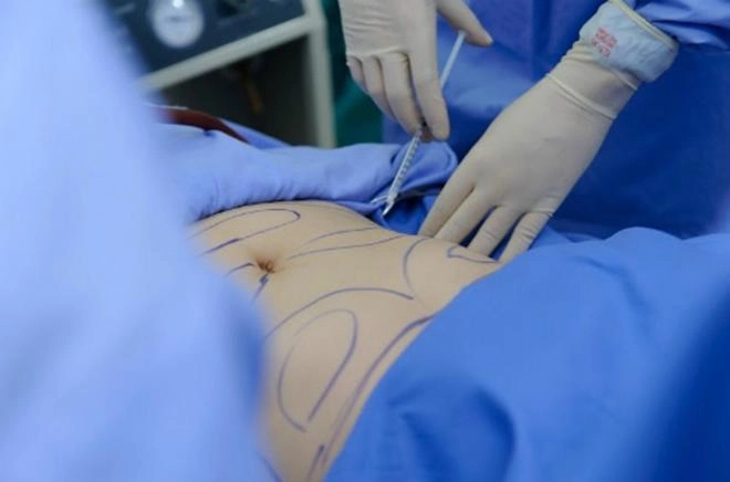 Hút mỡ bụng có thật sự là phương pháp thẩm mỹ thần thánh như quảng cáo