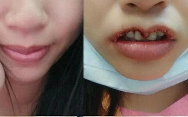 Khi bạn muốn đôi môi trái tim còn bác sĩ lại muốn khắc nguyên hình trái tim lên mặt bạn