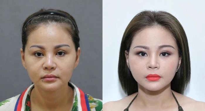 Kỷ lục những lần dao kéo nghe qua thấy thót tim của các nữ hoàng thẩm mỹ việt