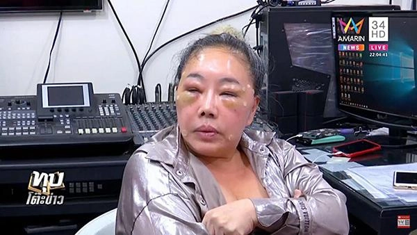 Mặt biến dạng hậu thẩm mỹ - liệu nữ đại gia u60 có thể tuyển chồng phi công thứ 13