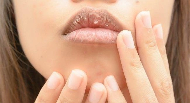 Môi khô nứt nẻ ngày đông nhờ có 5 cách trị này mà mềm mại căng mọng sau 1 đêm