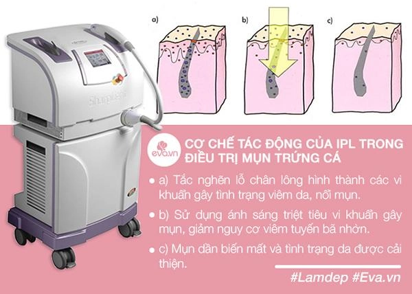 Mụn đỏ bay sạch sẹo lồi sẹo lõm không thành vấn đề chỉ với phương pháp này