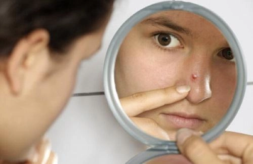Mụn mủ sưng đỏ cũng xẹp lép với những nguyên liệu chưa đến 10 ngàn đồng