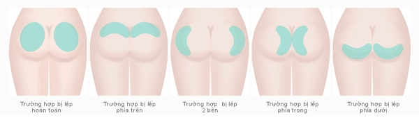 Muốn mông tấn công với số đo khủng đây là những phương pháp thẩm mỹ bạn cần biết