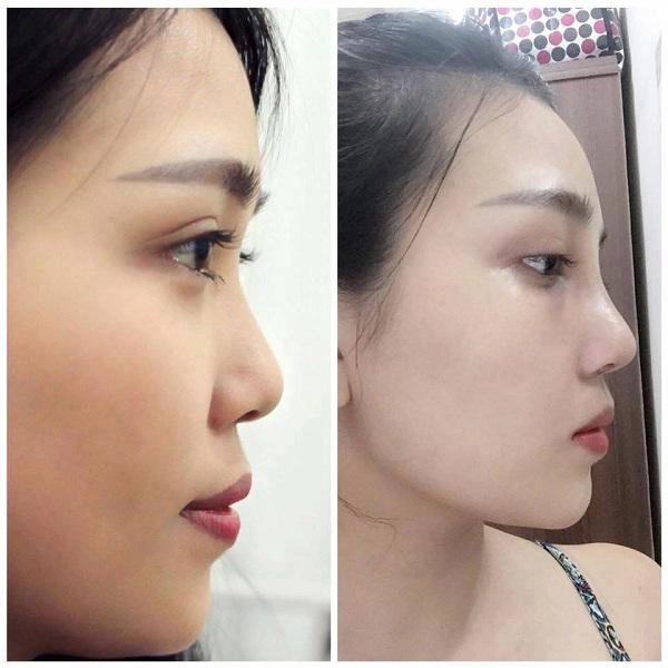 Nâng mũi hàn quốc và những kiến thức quan trọng bạn buộc phải biết