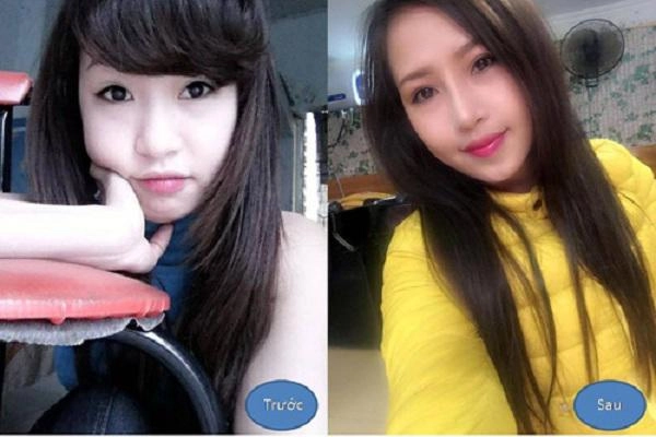 Nâng mũi hàn quốc và những kiến thức quan trọng bạn buộc phải biết