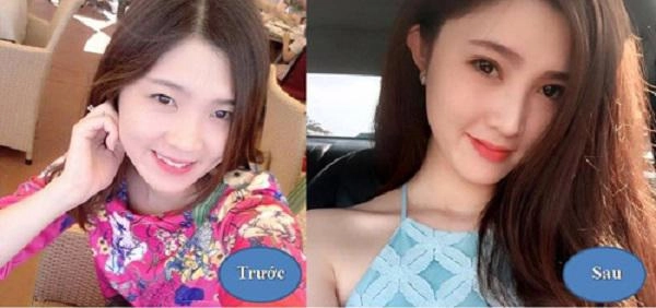 Nâng mũi hàn quốc và những kiến thức quan trọng bạn buộc phải biết