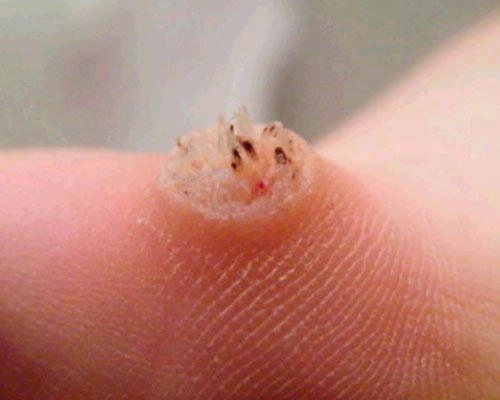 Nếu còn chưa biết mụn cóc có nguy hiểm không thì hãy cập nhật ngay các kiến thức này