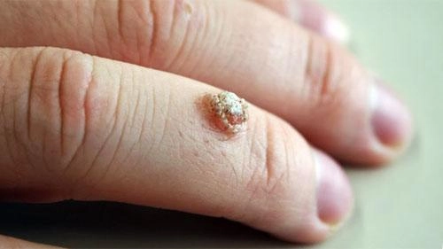 Nếu còn chưa biết mụn cóc có nguy hiểm không thì hãy cập nhật ngay các kiến thức này