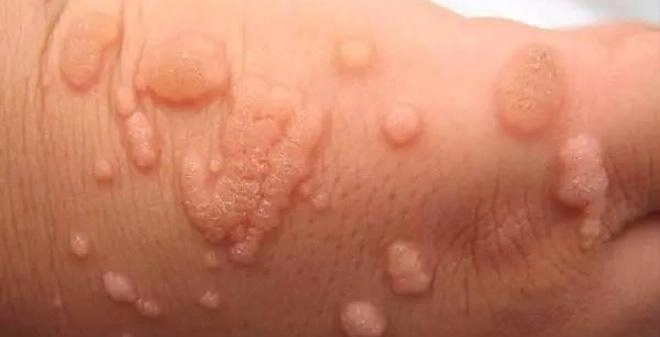 Nếu còn chưa biết mụn cóc có nguy hiểm không thì hãy cập nhật ngay các kiến thức này