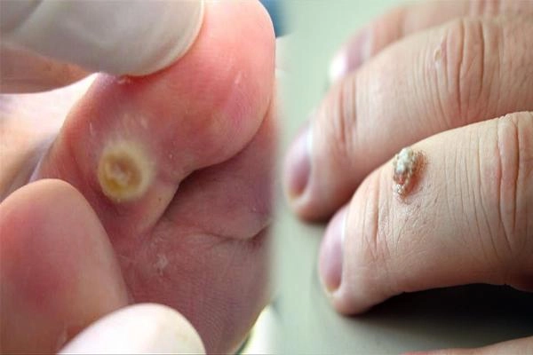 Nếu còn chưa biết mụn cóc có nguy hiểm không thì hãy cập nhật ngay các kiến thức này