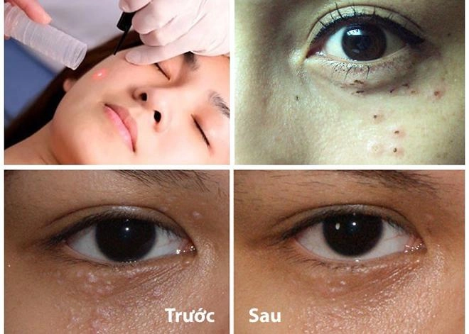 Nếu gặp phải những loại mụn này đừng dại động vào mà hãy để chúng tự sinh tự diệt