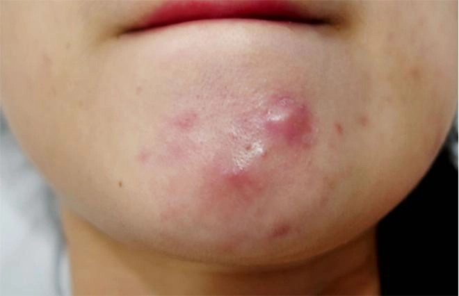 Nếu gặp phải những loại mụn này đừng dại động vào mà hãy để chúng tự sinh tự diệt