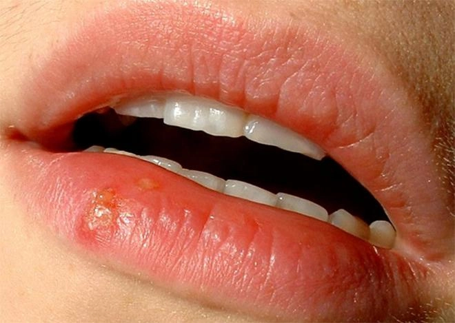 Nếu gặp phải những loại mụn này đừng dại động vào mà hãy để chúng tự sinh tự diệt