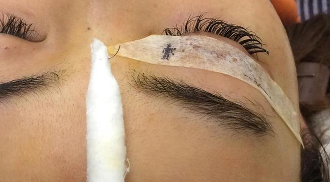 Nhấn mí ở cơ sở spa tư nhân cô gái 9x bị lạc trôi kim mổ vào mí mắt