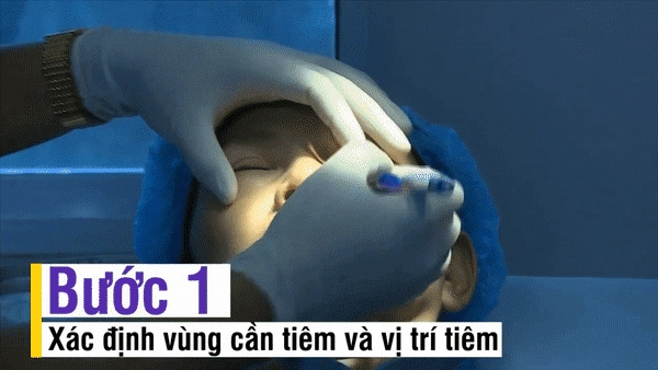Nhẹ nhàng không đau không chảy máu bảo sao người người nhà nhà dẫn nhau đi tiêm filler
