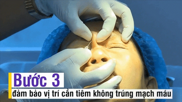 Nhẹ nhàng không đau không chảy máu bảo sao người người nhà nhà dẫn nhau đi tiêm filler