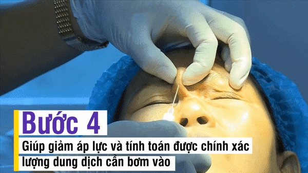 Nhẹ nhàng không đau không chảy máu bảo sao người người nhà nhà dẫn nhau đi tiêm filler