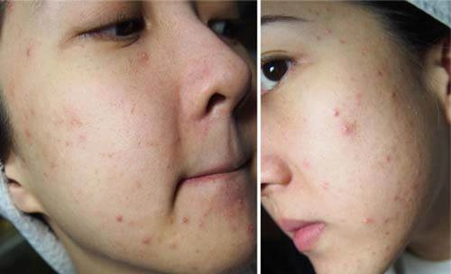 Những sai lầm ngày nào cũng mắc khiến mặt bạn ngày càng nhiều mụn hơn