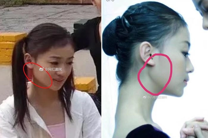 Nổi tiếng chưa lâu ngụy anh lạc bị tố độn cằm lộ ảnh quá khứ khác xa hiện tại