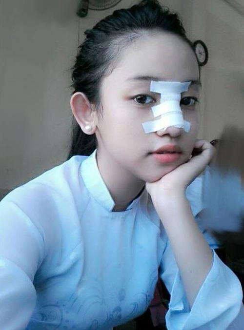 Phẫu thuật nâng mũi có ảnh hưởng gì không đọc bài viết dưới đây bạn sẽ rõ