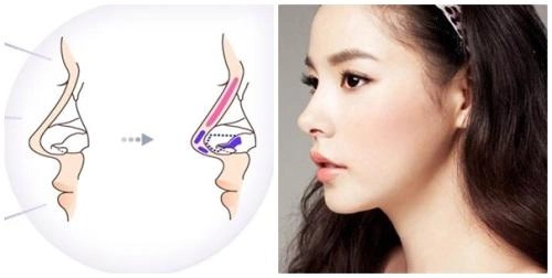 Phẫu thuật nâng mũi có ảnh hưởng gì không đọc bài viết dưới đây bạn sẽ rõ