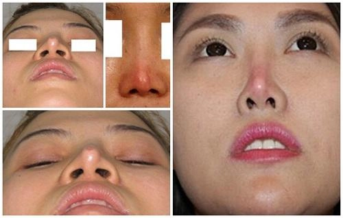 Phẫu thuật nâng mũi có ảnh hưởng gì không đọc bài viết dưới đây bạn sẽ rõ