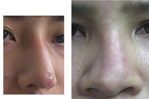 Phẫu thuật nâng mũi có ảnh hưởng gì không đọc bài viết dưới đây bạn sẽ rõ
