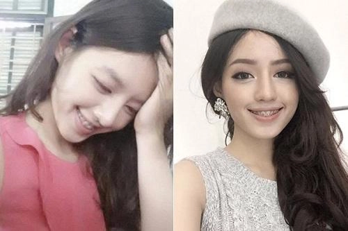 Răng sắt thì mặc răng sắt hoàng thùy khánh linh vẫn tự tin khoe nụ cười tỏa nắng