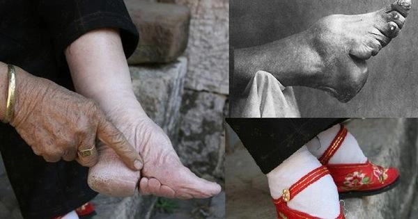 Rùng mình với những hủ tục làm đẹp chỉ nghe tên thôi đã đủ thấyđau