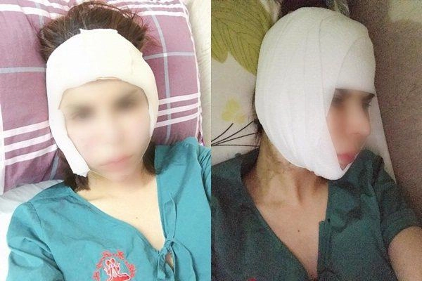 Sau biến chứng nạo silicone hot girl chuyển giới triệu followers tiếp tục khoe ảnh sửa mũi