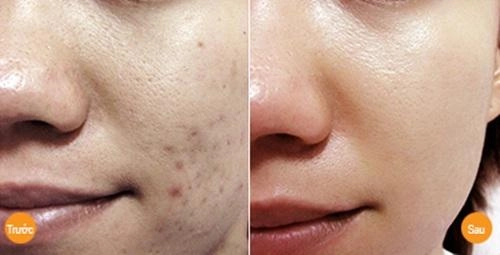 Sẹo thâm lâu năm cứng đầu đến mấy cũng phải đầu hàng với những mẹo dưới đây