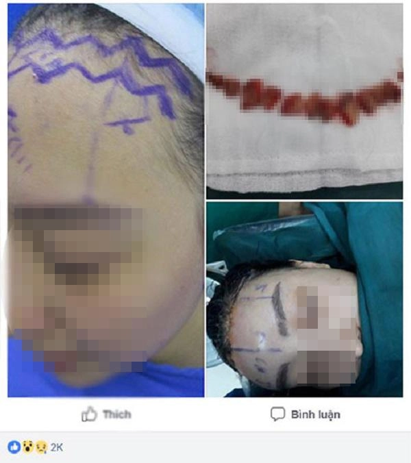 Sửa mũi cắt môi đã là gì chị em bây giờ còn rủ nhau đi cắt da đầu để