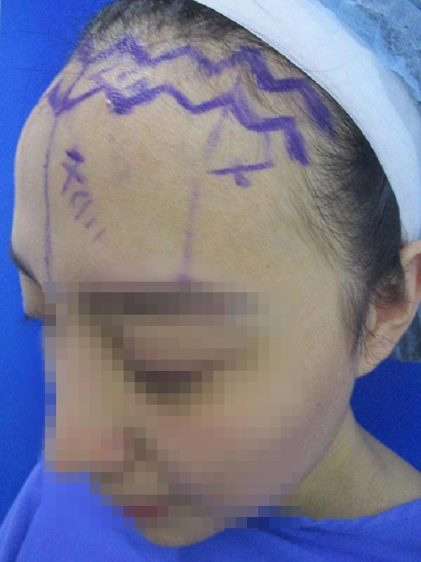 Sửa mũi cắt môi đã là gì chị em bây giờ còn rủ nhau đi cắt da đầu để