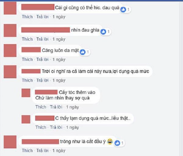 Sửa mũi cắt môi đã là gì chị em bây giờ còn rủ nhau đi cắt da đầu để