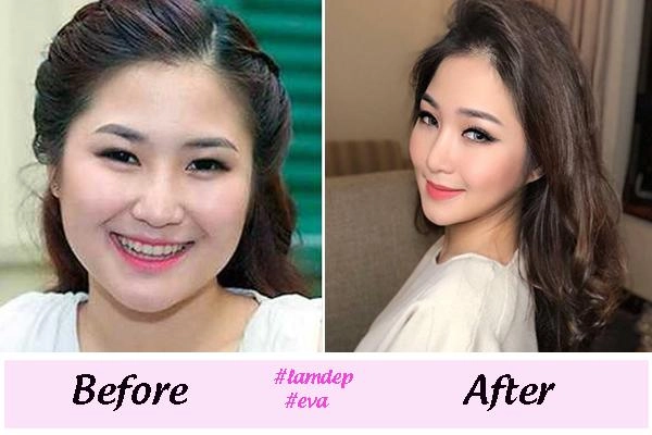 Thay đổi diện mạo chóng mặt những sao việt này dính nghi vấn độn cằm v line