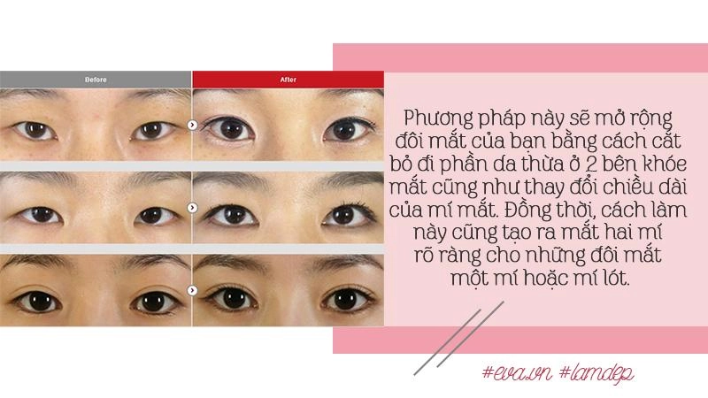 Thích mắt to nhờ cắt mí chưa đủ chị em còn muốn mắt dài nhờ phẫu thuật mở tròng mắt