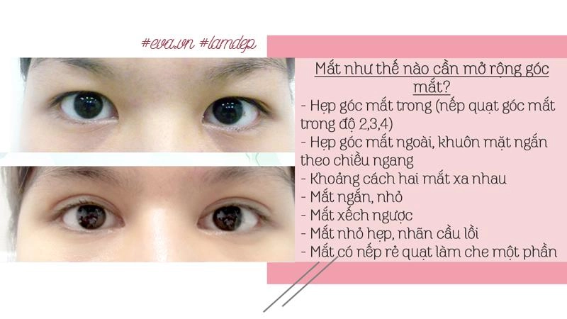 Thích mắt to nhờ cắt mí chưa đủ chị em còn muốn mắt dài nhờ phẫu thuật mở tròng mắt