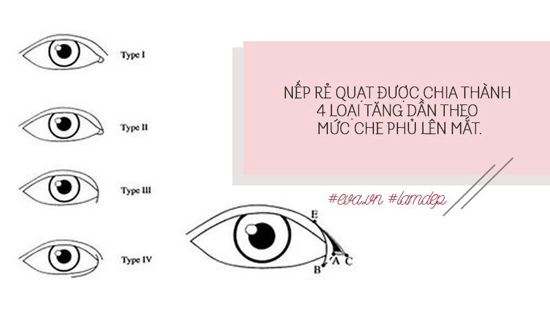 Thích mắt to nhờ cắt mí chưa đủ chị em còn muốn mắt dài nhờ phẫu thuật mở tròng mắt