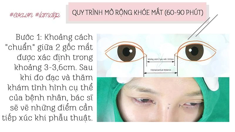Thích mắt to nhờ cắt mí chưa đủ chị em còn muốn mắt dài nhờ phẫu thuật mở tròng mắt