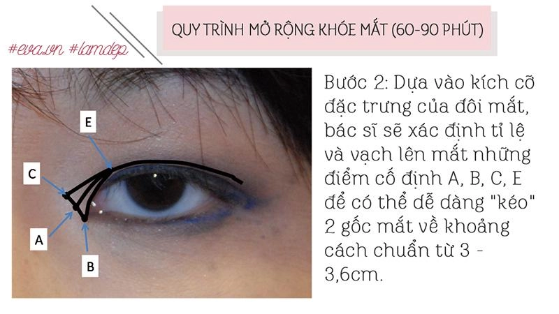 Thích mắt to nhờ cắt mí chưa đủ chị em còn muốn mắt dài nhờ phẫu thuật mở tròng mắt
