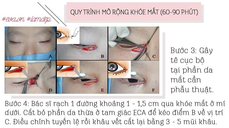 Thích mắt to nhờ cắt mí chưa đủ chị em còn muốn mắt dài nhờ phẫu thuật mở tròng mắt