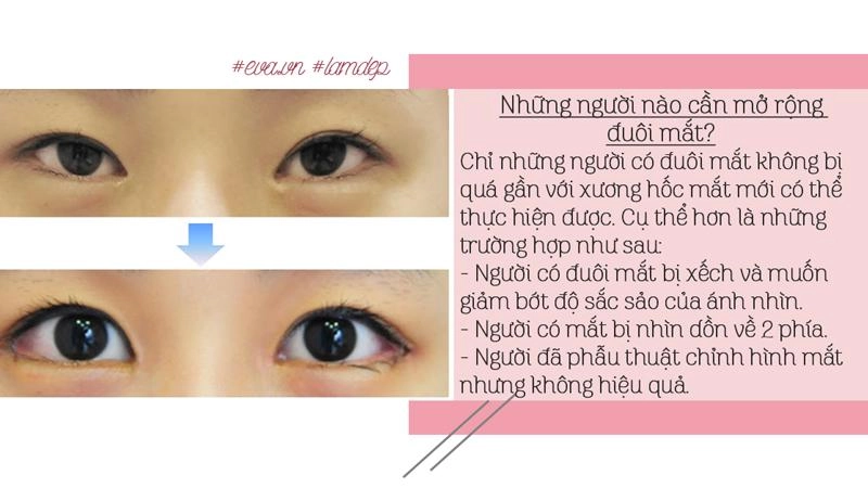 Thích mắt to nhờ cắt mí chưa đủ chị em còn muốn mắt dài nhờ phẫu thuật mở tròng mắt
