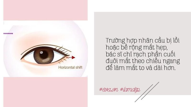 Thích mắt to nhờ cắt mí chưa đủ chị em còn muốn mắt dài nhờ phẫu thuật mở tròng mắt