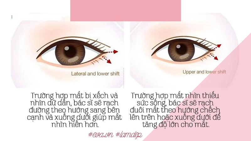 Thích mắt to nhờ cắt mí chưa đủ chị em còn muốn mắt dài nhờ phẫu thuật mở tròng mắt