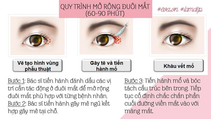 Thích mắt to nhờ cắt mí chưa đủ chị em còn muốn mắt dài nhờ phẫu thuật mở tròng mắt