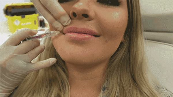 Tiêm filler làm dày môi và những dáng môi hot nhất năm 2018 các nàng cần cập nhật